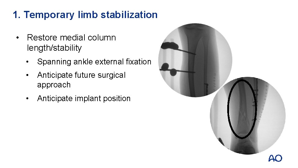 1. Temporary limb stabilization • Restore medial column length/stability • Spanning ankle external fixation