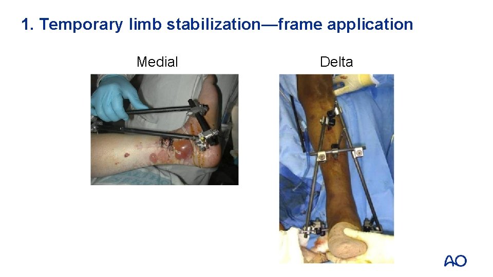 1. Temporary limb stabilization—frame application Medial Delta 