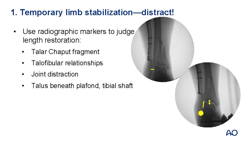 1. Temporary limb stabilization—distract! • Use radiographic markers to judge length restoration: • Talar