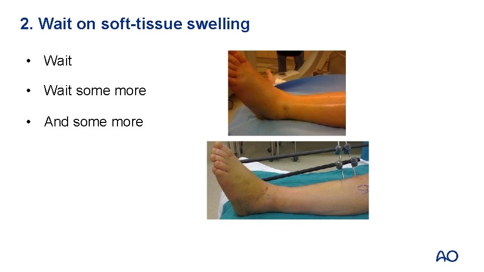 2. Wait on soft-tissue swelling • Wait some more • And some more 