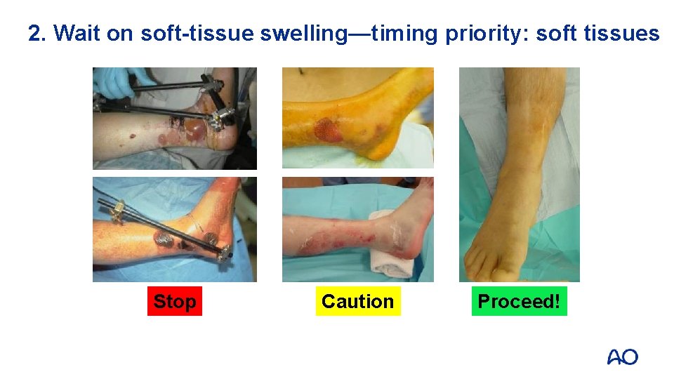 2. Wait on soft-tissue swelling—timing priority: soft tissues Stop Caution Proceed! 