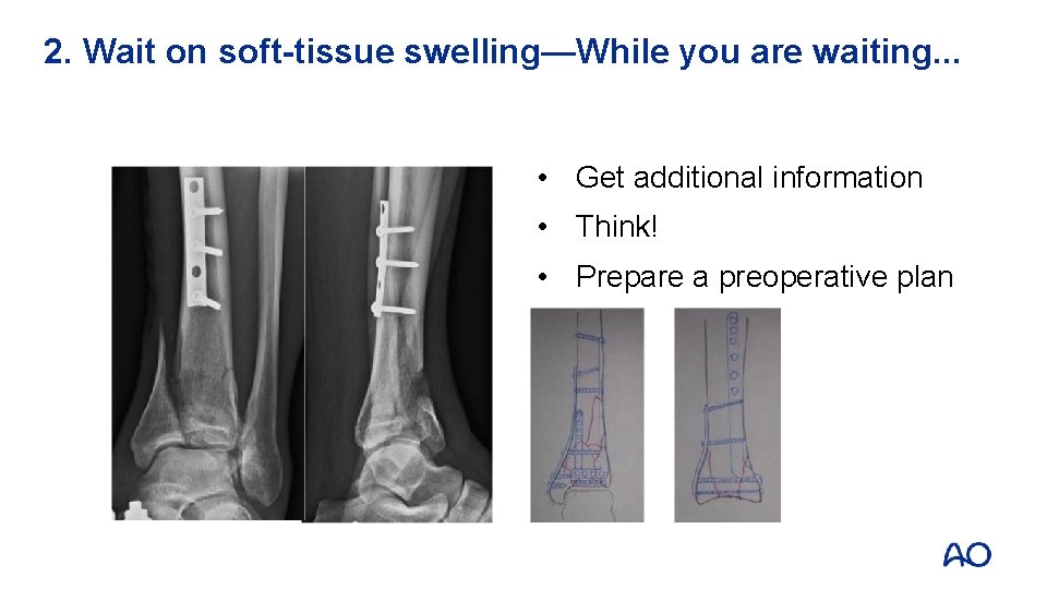 2. Wait on soft-tissue swelling—While you are waiting. . . • Get additional information
