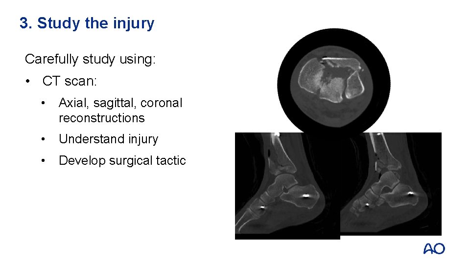 3. Study the injury Carefully study using: • CT scan: • Axial, sagittal, coronal