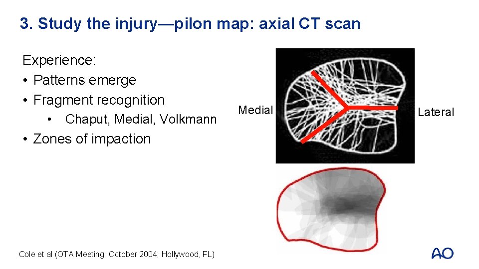3. Study the injury—pilon map: axial CT scan Experience: • Patterns emerge • Fragment