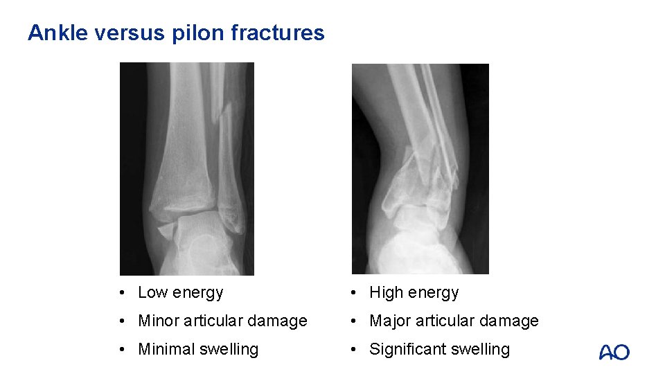 Ankle versus pilon fractures • Low energy • High energy • Minor articular damage