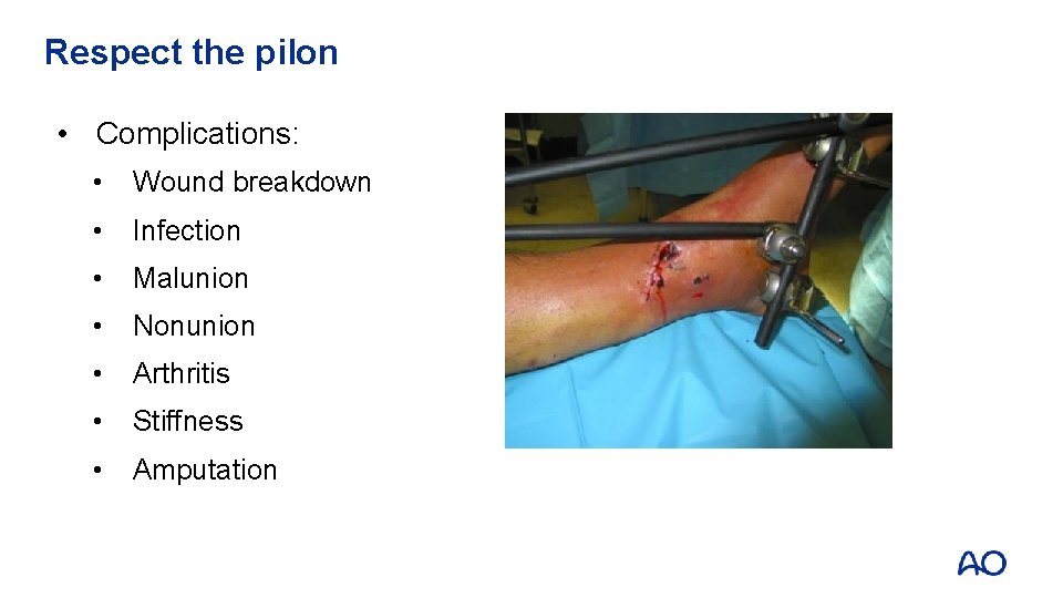 Respect the pilon • Complications: • Wound breakdown • Infection • Malunion • Nonunion