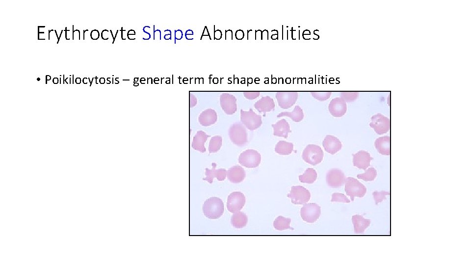 Erythrocyte Shape Abnormalities • Poikilocytosis – general term for shape abnormalities 