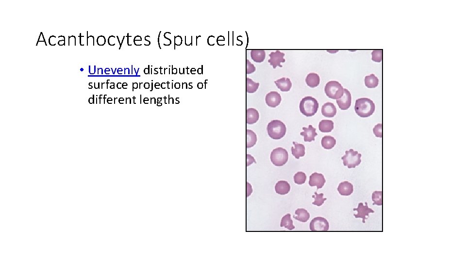 Acanthocytes (Spur cells) • Unevenly distributed surface projections of different lengths 