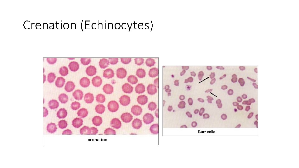 Crenation (Echinocytes) 