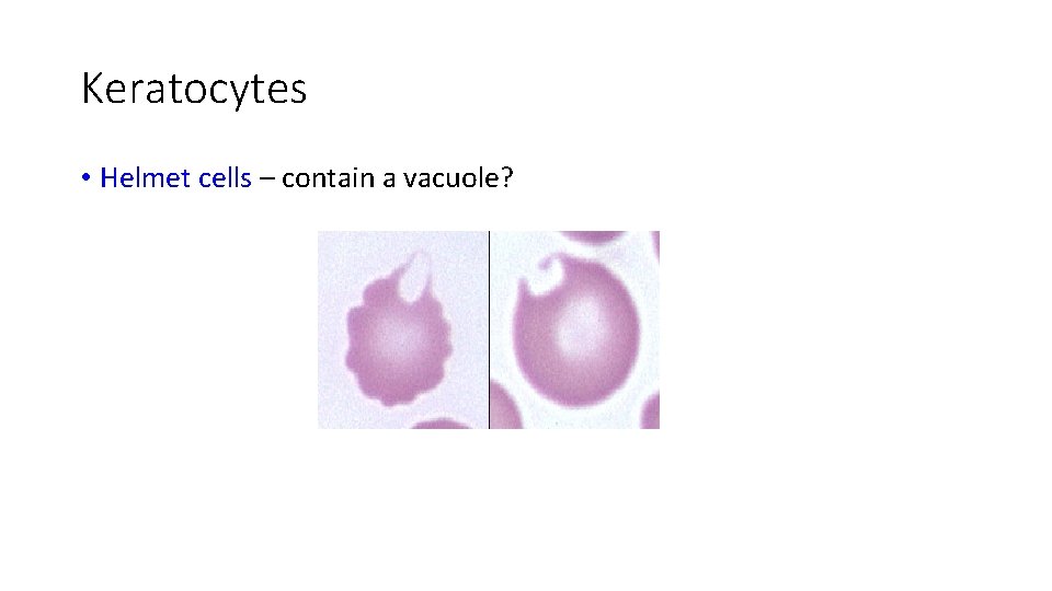 Keratocytes • Helmet cells – contain a vacuole? 