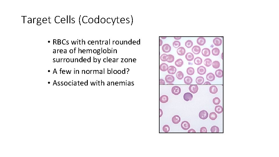Target Cells (Codocytes) • RBCs with central rounded area of hemoglobin surrounded by clear
