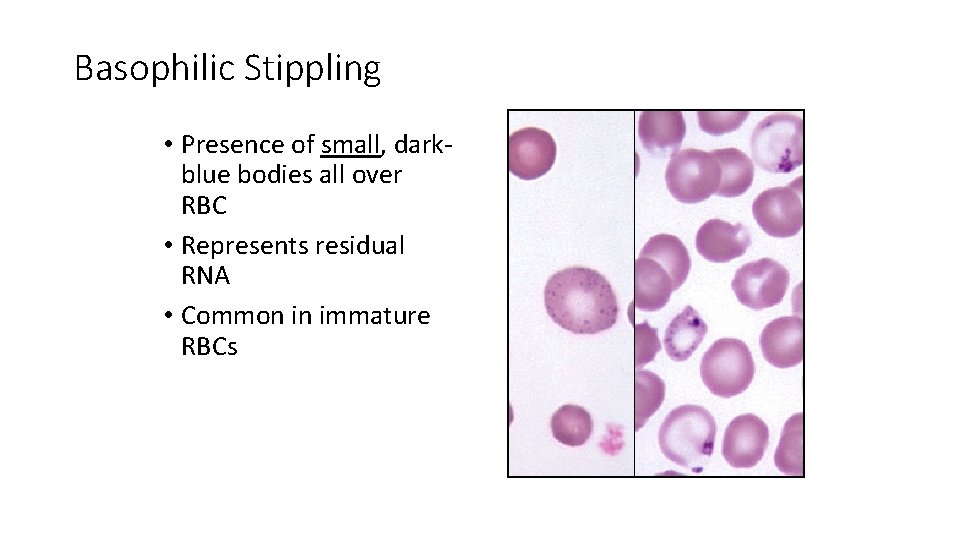 Basophilic Stippling • Presence of small, darkblue bodies all over RBC • Represents residual