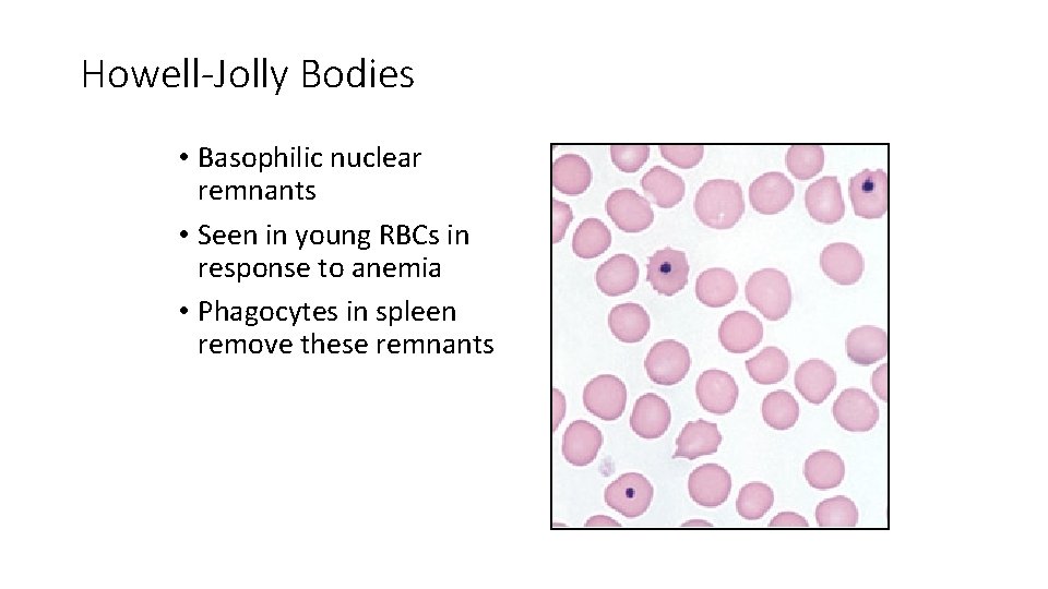 Howell-Jolly Bodies • Basophilic nuclear remnants • Seen in young RBCs in response to