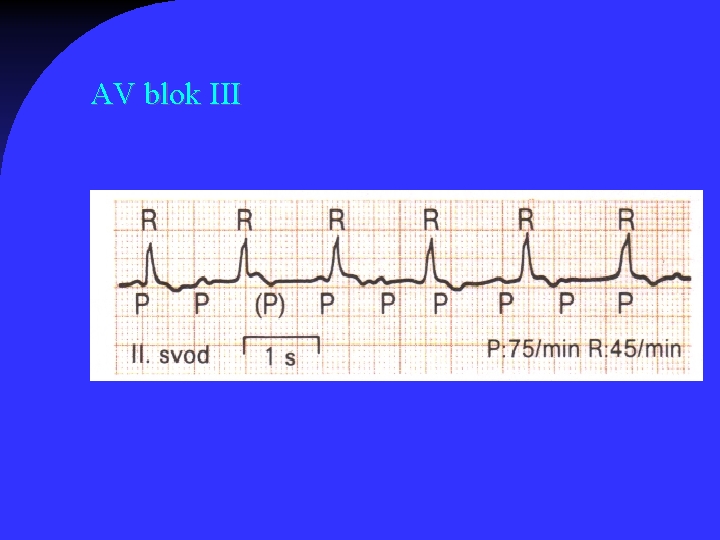 AV blok III 