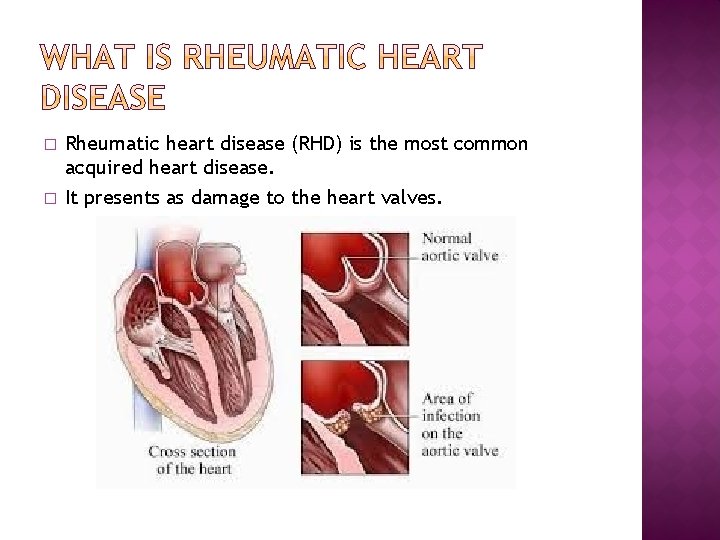 � � Rheumatic heart disease (RHD) is the most common acquired heart disease. It