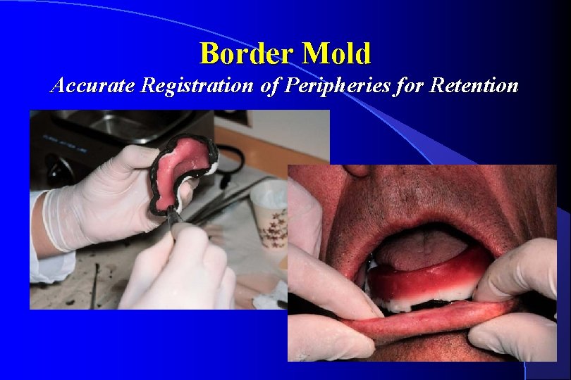 Border Mold Accurate Registration of Peripheries for Retention 