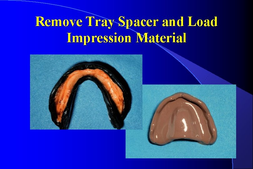 Remove Tray Spacer and Load Impression Material 