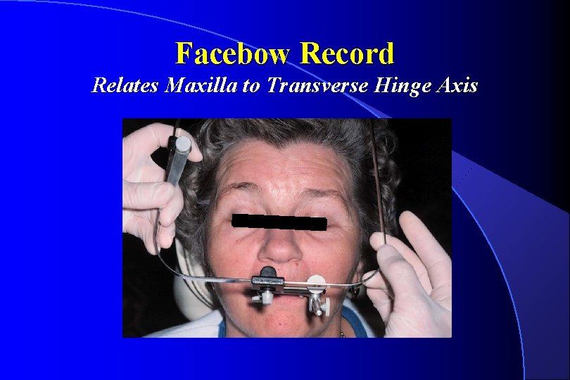 Facebow Record Relates Maxilla to Transverse Hinge Axis 