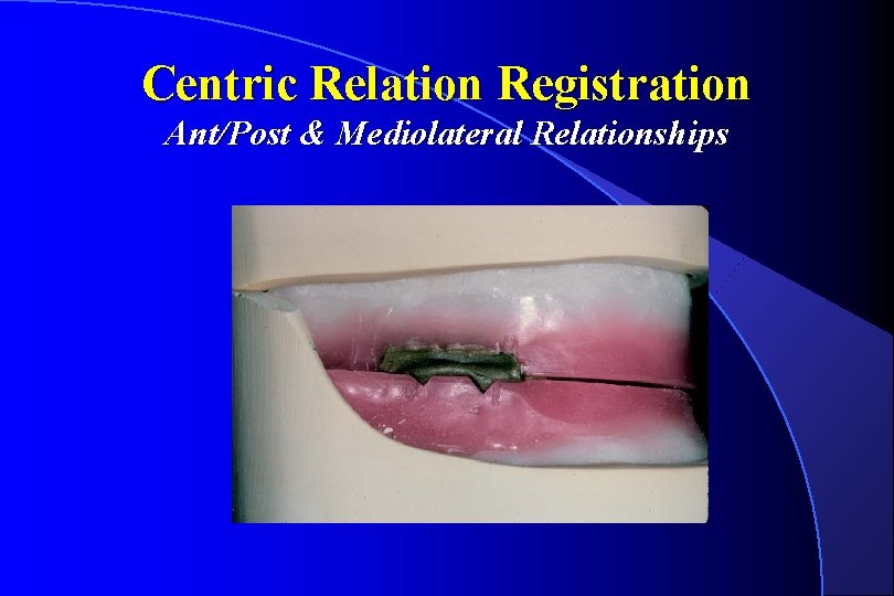 Centric Relation Registration Ant/Post & Mediolateral Relationships 