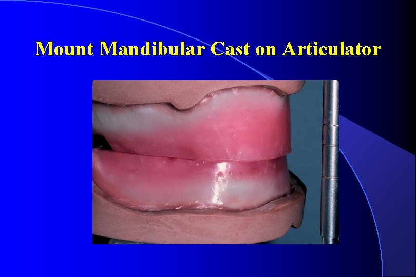 Mount Mandibular Cast on Articulator 