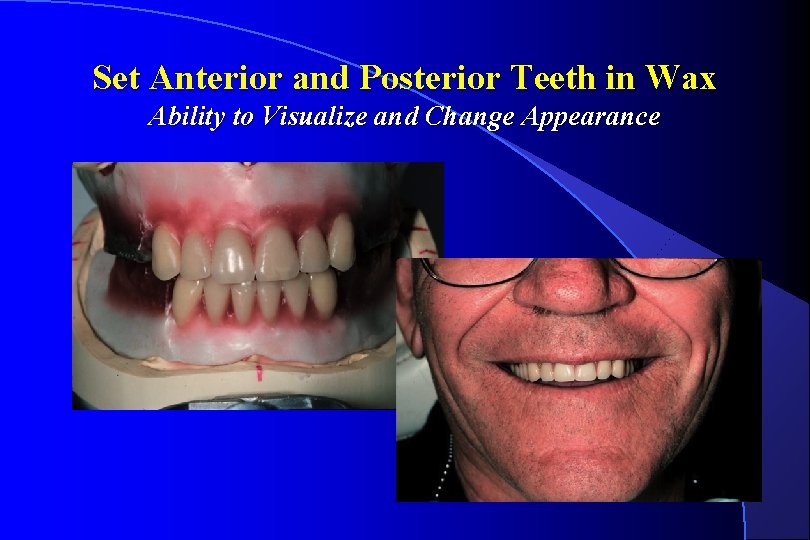 Set Anterior and Posterior Teeth in Wax Ability to Visualize and Change Appearance 