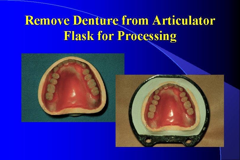 Remove Denture from Articulator Flask for Processing 