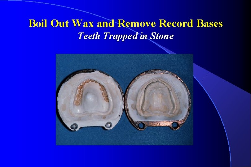 Boil Out Wax and Remove Record Bases Teeth Trapped in Stone 