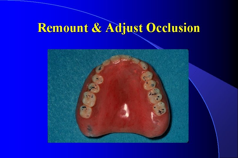Remount & Adjust Occlusion 