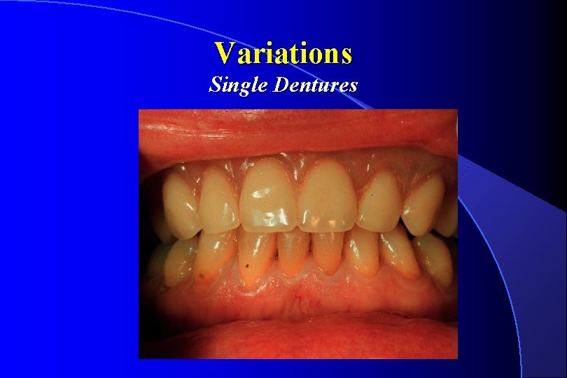 Variations Single Dentures 