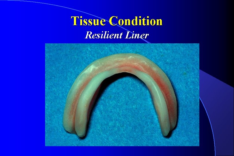Tissue Condition Resilient Liner 