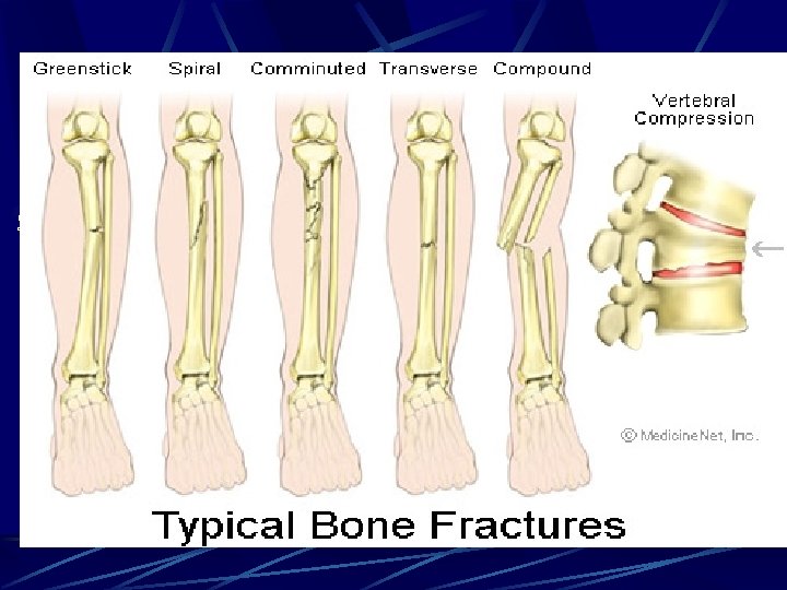 Next, there needs to be a description of the fracture line. Does the fracture