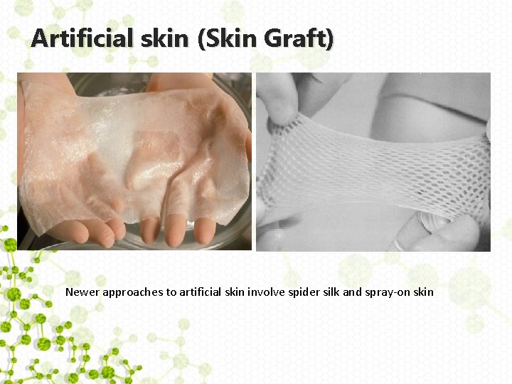Artificial skin (Skin Graft) Newer approaches to artificial skin involve spider silk and spray-on