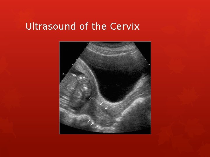 Ultrasound of the Cervix 