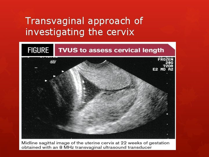 Transvaginal approach of investigating the cervix 