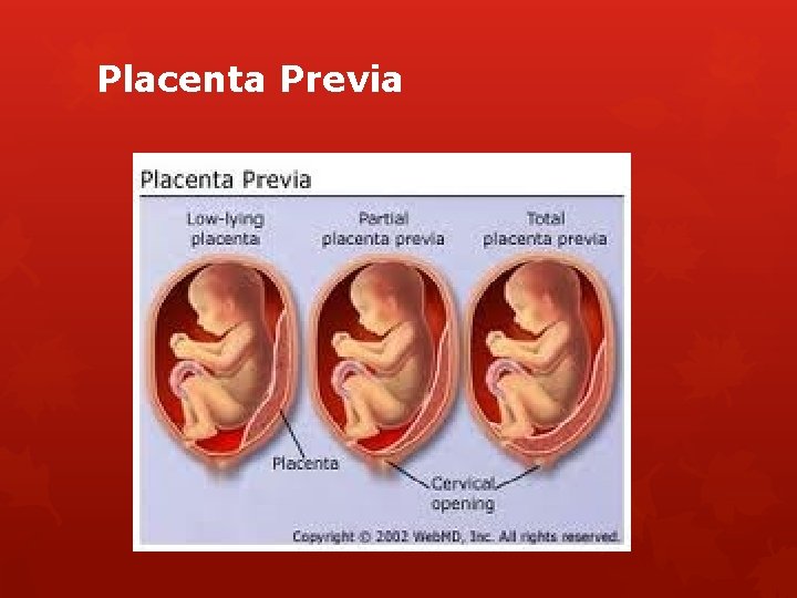 Placenta Previa 