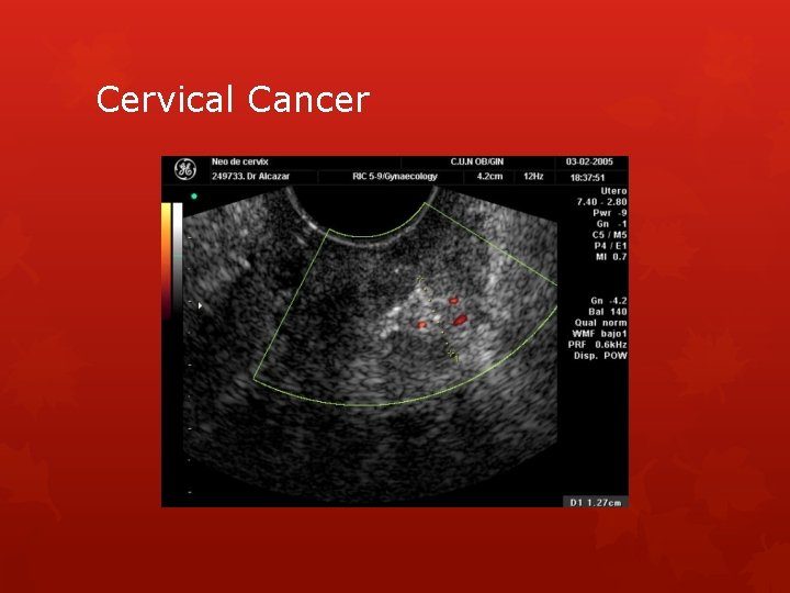 Cervical Cancer 