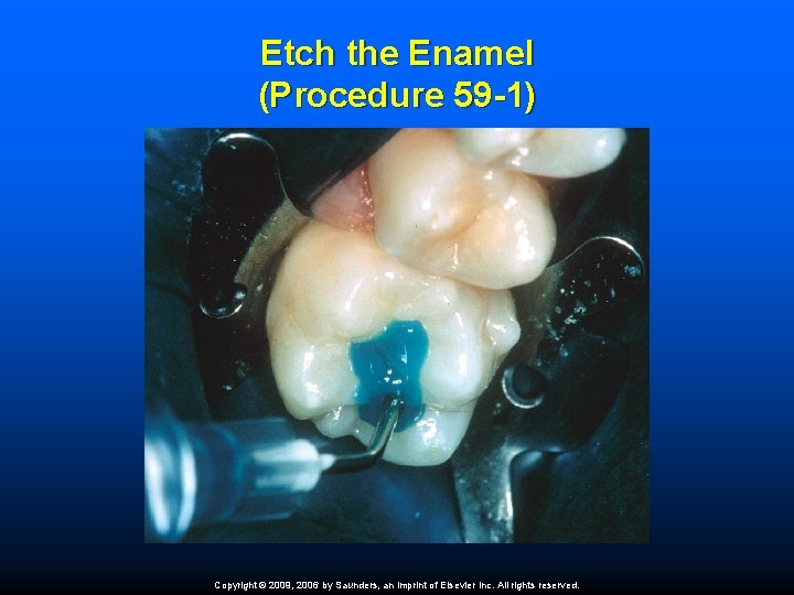 Etch the Enamel (Procedure 59 -1) Copyright © 2009, 2006 by Saunders, an imprint