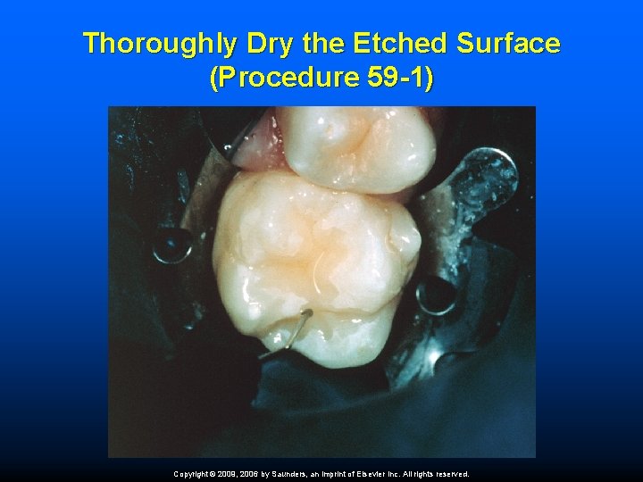 Thoroughly Dry the Etched Surface (Procedure 59 -1) Copyright © 2009, 2006 by Saunders,