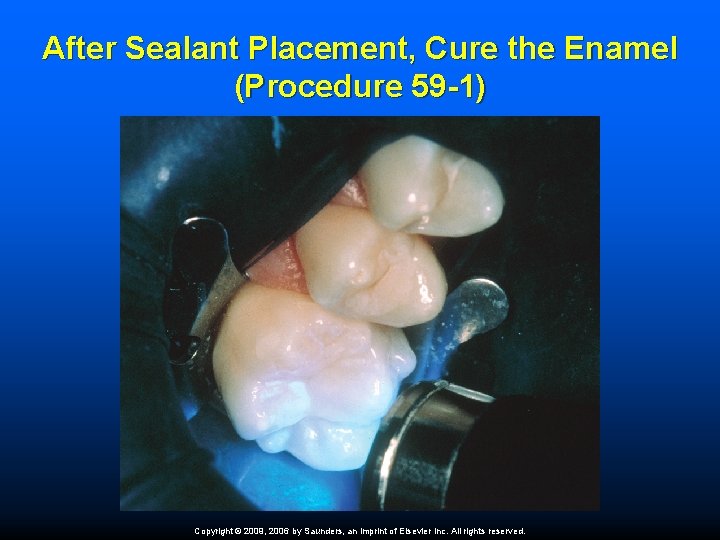 After Sealant Placement, Cure the Enamel (Procedure 59 -1) Copyright © 2009, 2006 by