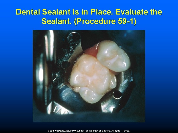 Dental Sealant Is in Place. Evaluate the Sealant. (Procedure 59 -1) Copyright © 2009,