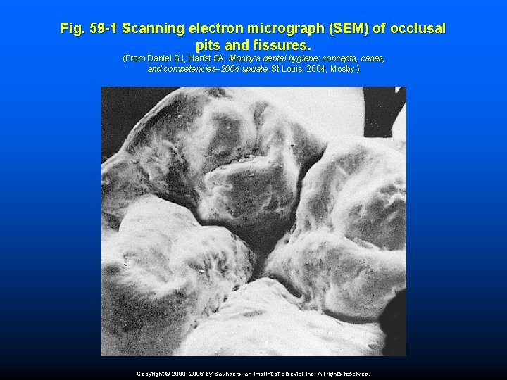 Fig. 59 -1 Scanning electron micrograph (SEM) of occlusal pits and fissures. (From Daniel