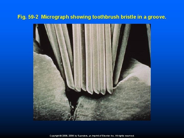 Fig. 59 -2 Micrograph showing toothbrush bristle in a groove. Copyright © 2009, 2006