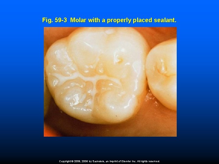 Fig. 59 -3 Molar with a properly placed sealant. Copyright © 2009, 2006 by