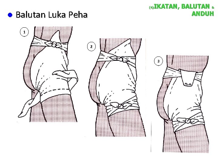 l IKATAN, BALUTAN & ANDUH (4) Balutan Luka Peha 1 2 3 