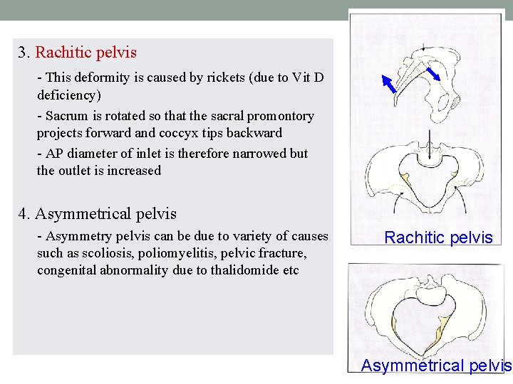 3. Rachitic pelvis - This deformity is caused by rickets (due to Vit D