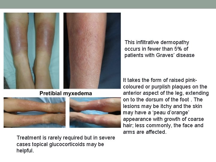 This infiltrative dermopathy occurs in fewer than 5% of patients with Graves’ disease Treatment