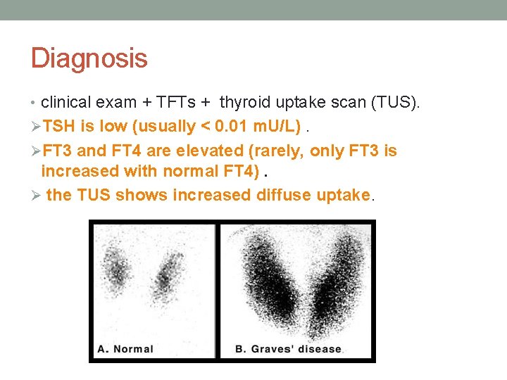 Diagnosis • clinical exam + TFTs + thyroid uptake scan (TUS). ØTSH is low