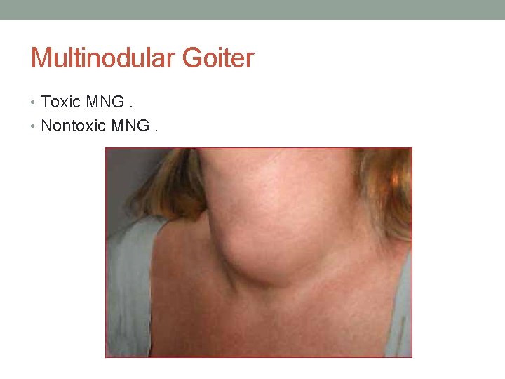 Multinodular Goiter • Toxic MNG. • Nontoxic MNG. 
