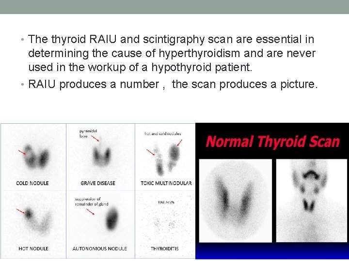  • The thyroid RAIU and scintigraphy scan are essential in determining the cause