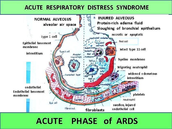 ACUTE RESPIRATORY DISTRESS SYNDROME NORMAL ALVEOLUS alveolar air space INJURED ALVEOLUS Protein-rich edema fluid